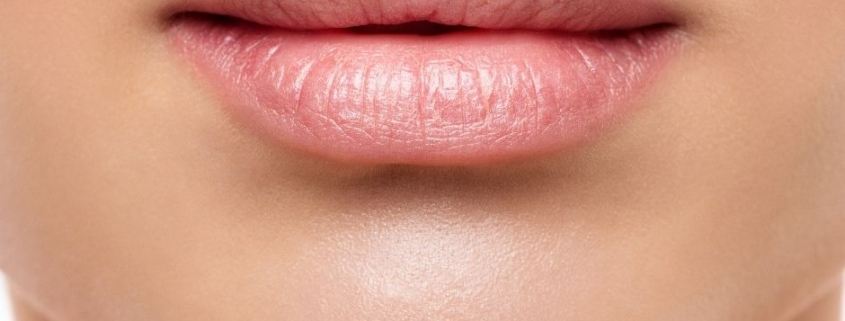 Filler-lips